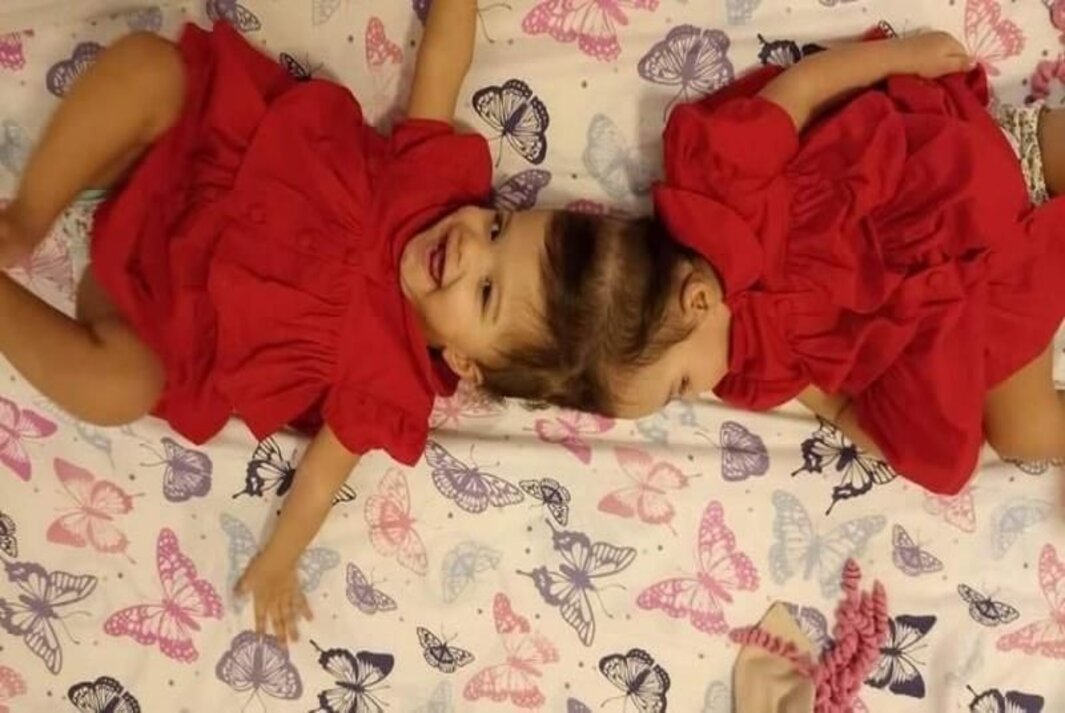Siamesas de Piquerobi respondem bem após cirurgia de 9 horas, diz hospital