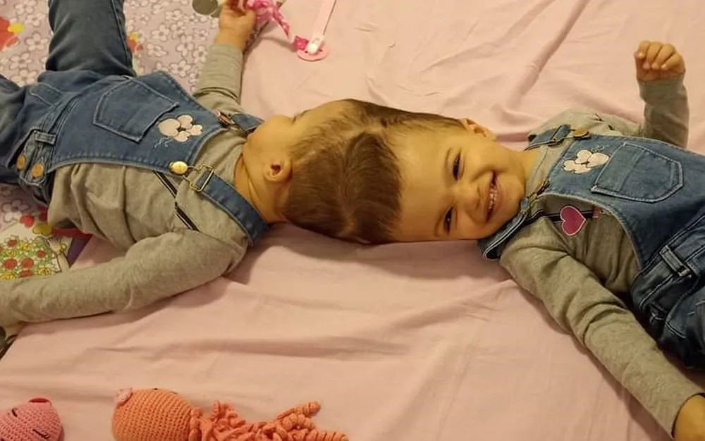 'Boa Evolução'; Gêmeas siamesas de Piquerobi, realizaram cirurgia final de separação, no Hospital das Clínicas em Ribeirão Preto!