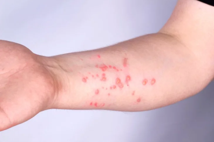'Monkeypox'; Vigilância Epidemiológica confirma primeiro caso positivo em Prudente, e mais três suspeitos na região!