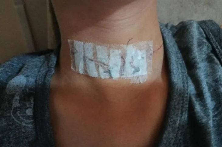 'Perigo do Cerol'; Garoto se recupera após ser ferido por linha cortante no pescoço, em Anastácio!