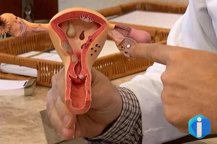 Aberta chamada pública para pesquisas sobre endometriose