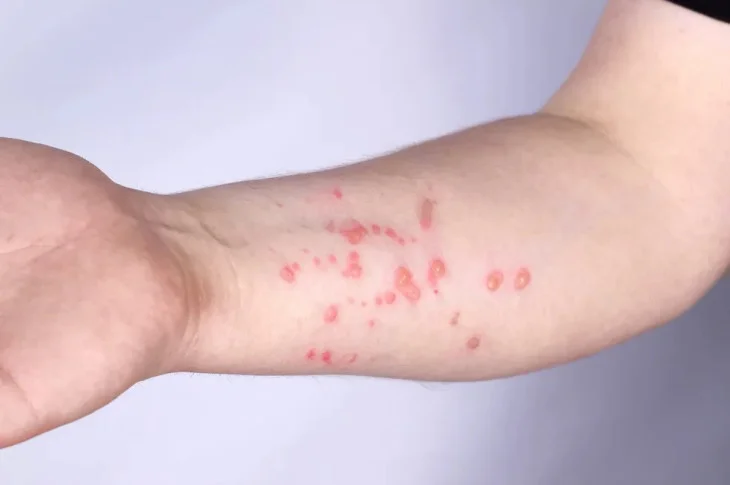 Grupo de Vigilância Epidemiológica contabiliza 7 casos de monkeypox em Presidente Prudente