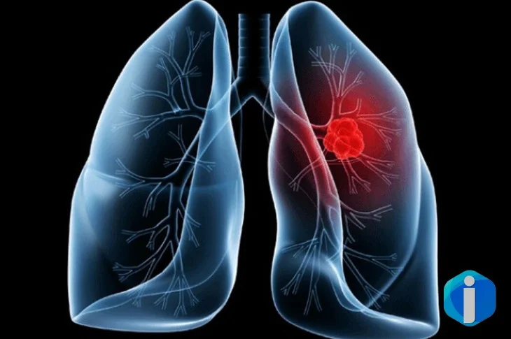 Saiba o que é adenocarcinoma pulmonar, câncer que atinge o papa
